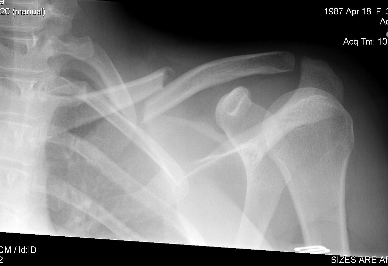 Clavicle Fracture Shortened